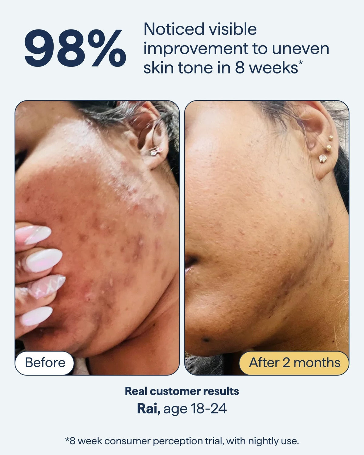 Remedy for Dark Spots | Advanced Night Treatment with Retinol & Kojic Acid | For Discoloration and Uneven Tones | With Glutathione - PrimeBioHealth - canada supplements